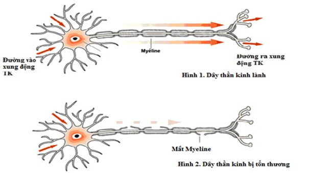 Spasticity immediately by Guillain - Barré syndrome