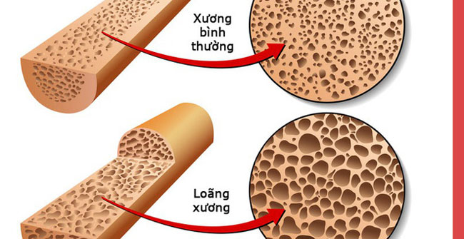 Specialists give advice to keep your bones healthy and prevent osteoporosis