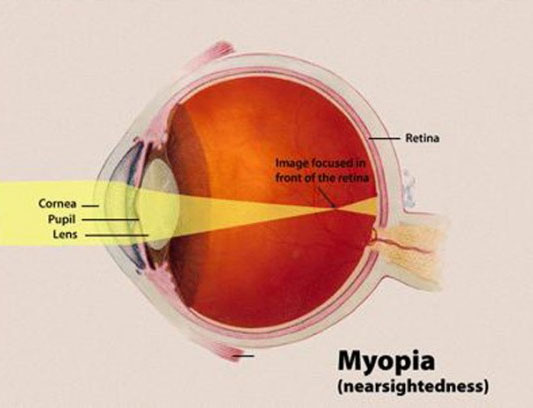 Specialized contact lenses prevent myopia in children