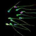 Sperm luteum - complication of infection