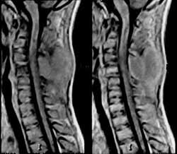 Spinal tuberculosis can be cured it?