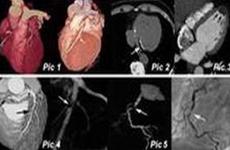 Stable angina - Heart danger