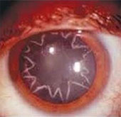 Staring in the eye after an electric shock