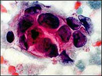 Stem cells can be a cause of cancer spread