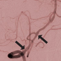 Stents increase the risk of death twice
