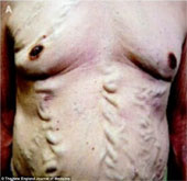 Strange disease: The blood vessels float like a snake under the skin