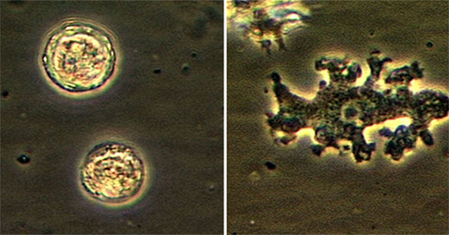 Strange patients in the US have brain eating amoeba while still ... living
