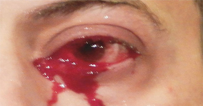 Strangely the man 'cried blood' continuously for ... 1 hour