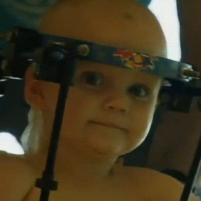 Successful head transplant surgery for one-year-old boys