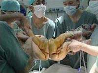 Successful separation of two boys with spinal cord attached