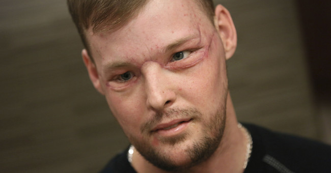 Successful surgery for rare facial transplants in the world