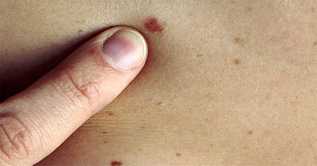 Successfully developed the system for early detection of skin cancer