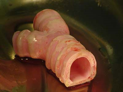 Successfully implanted artificial trachea made from stem cells