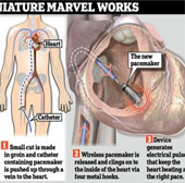 Successfully implanted wireless pacemaker