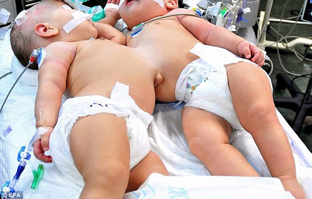 Successfully separated conjoined twins