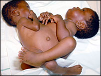Successfully separated twin girls