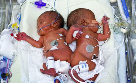 Successfully separated twins sticking to the spine