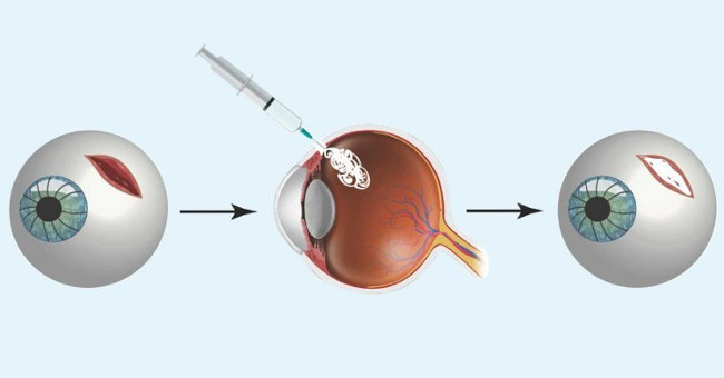 Super glue helps 'bandage' injured eyeballs within minutes