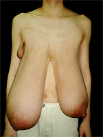 Surgery for a woman with a chest half a meter long