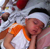 Symptoms and how to care for children with measles