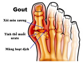 Symptoms, complications of gout and medication treatment