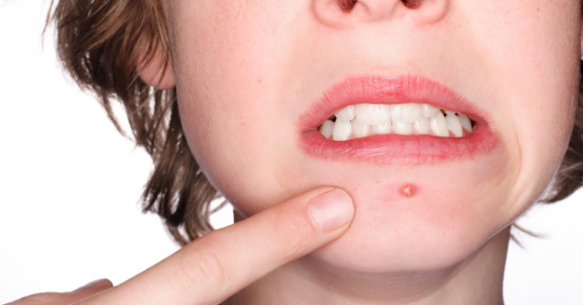 Symptoms of 5 common skin diseases in the summer