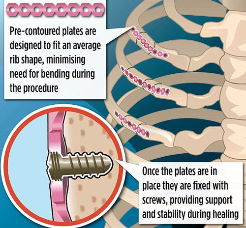 Synthes Rib Matrix - new surgical method that helps fracture to recover quickly