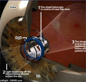 Technological breakthroughs in telescope in the eye