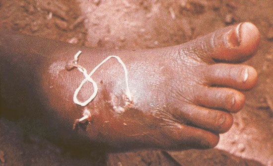 Terrible consequences from parasitic worms