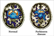 Testing gene therapy for Parkinson's disease