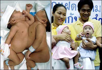 Thailand: Successfully separated conjoined twins heart