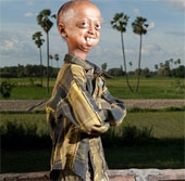 The 14-year-old boy has an old face