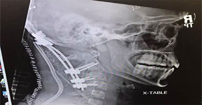 The 22-year-old boy shocked the medicine because he survived the accident