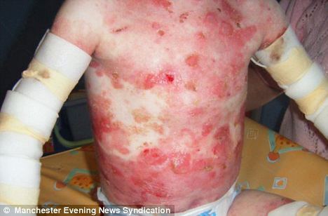 The 6-year-old boy always suffered from blistering skin