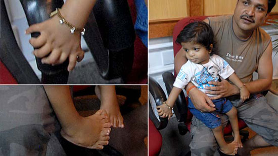 The boy has 34 fingers and legs in India