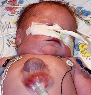 The boy has a heart outside his body