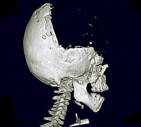 The boy has only half a skull