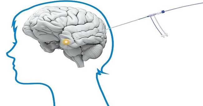 The brain cancer laser knife was first used in the UK