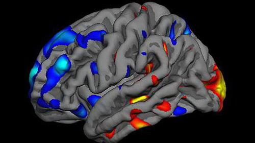 The brain scanner finds autism for 15 minutes