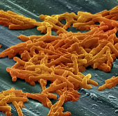 The cause of drug resistance is detected