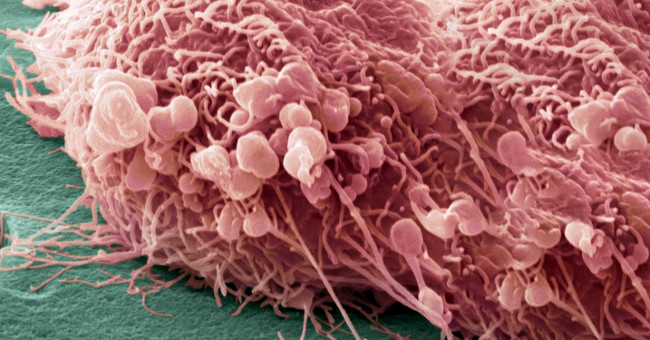 The cause of metastatic cancer cells has been found