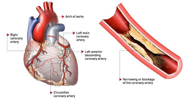 The culprit causes myocardial infarction