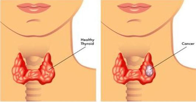 The culprit causing throat cancer should be avoided