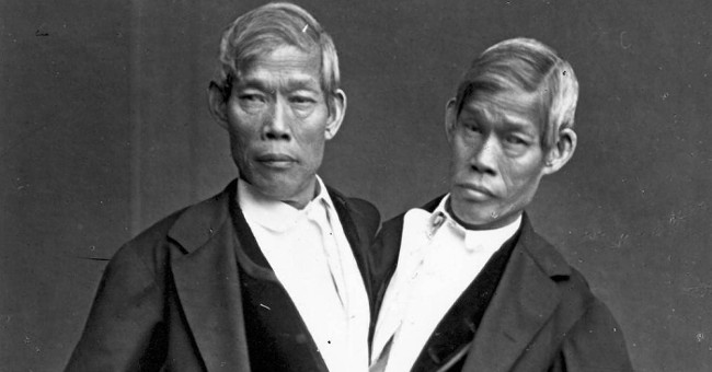 The curious life of conjoined twins 200 years ago