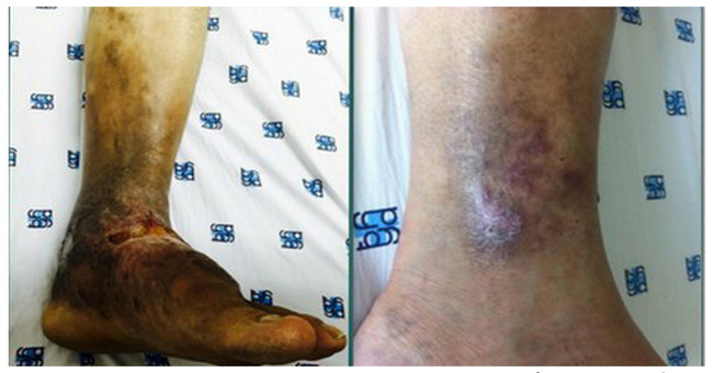 The dangerous disease can make you have to cut your leg