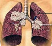 The demand for anticancer drugs is rising in Asia