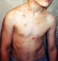 The effectiveness of chickenpox vaccine decreases with time