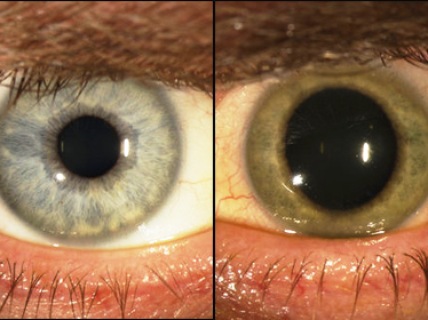 The eye changes color after curing Ebola
