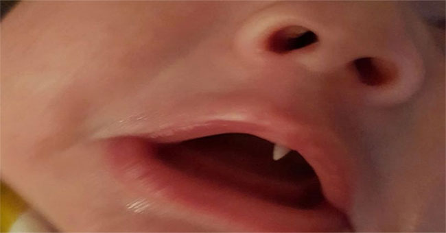 The fang like Dracula in the mouth of an 11-week-old baby
