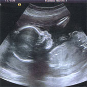 The fetus is born after 3 months in the brain dead